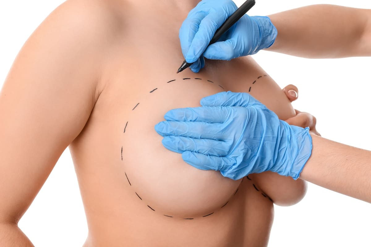 Resultado visual relacionado con Mamoplastia de Aumento